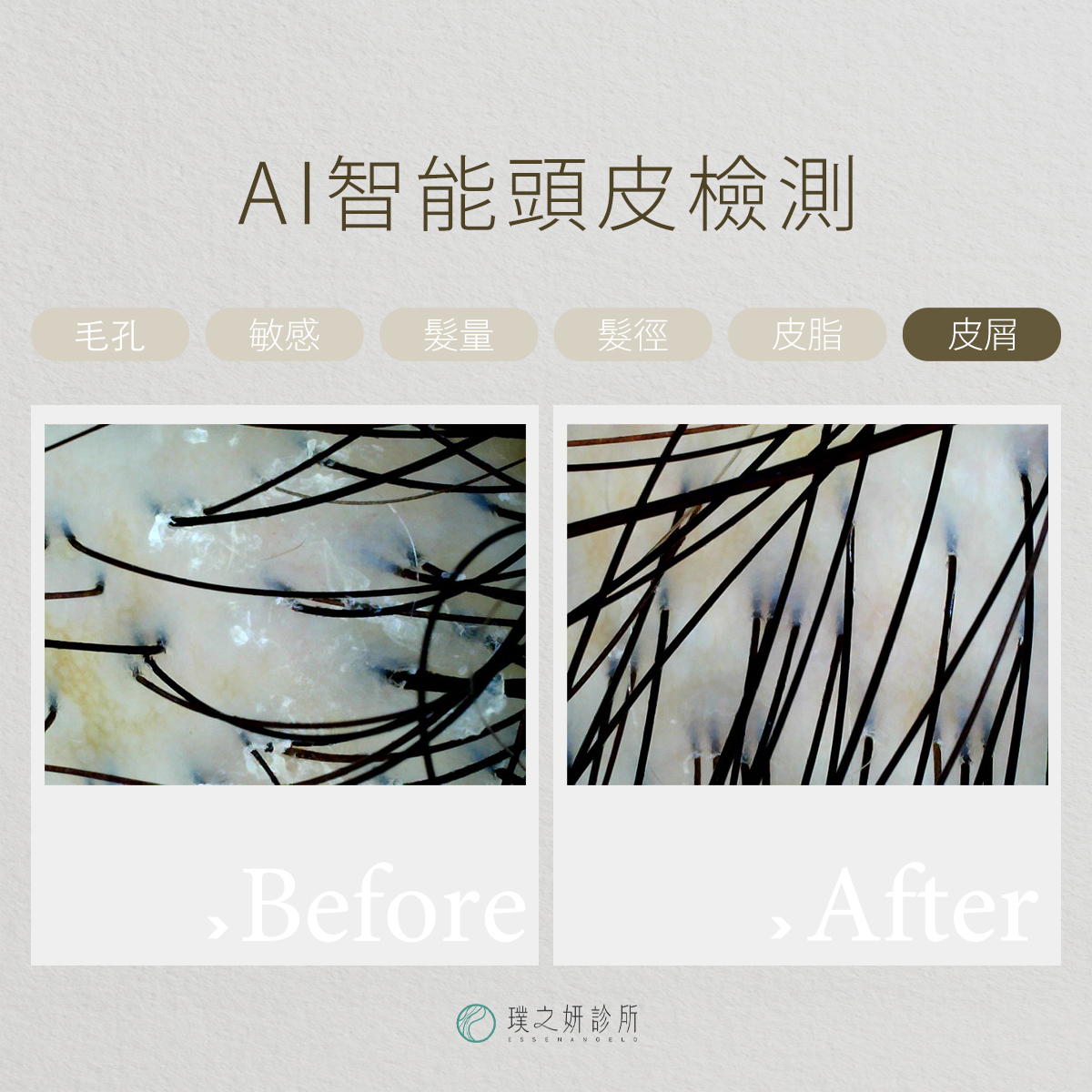 AI智能頭皮檢測＿皮屑ba