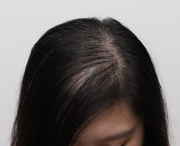 別再說「老了就會禿」！女性雄性禿其實可以逆轉 璞之妍 生髮中心